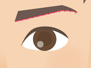 切開した皮膚を縫い合わせます