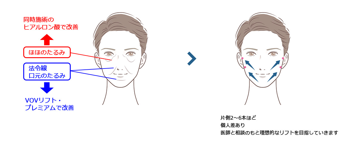 糸リフト　施術イメージ